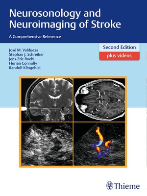 cover image of Neurosonology and Neuroimaging of Stroke